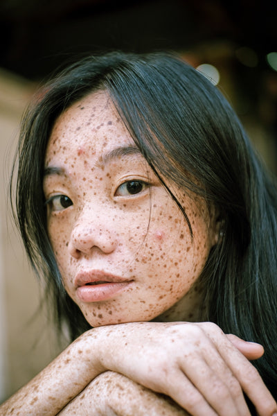 5 Natural Ways to Manage Or Get Rid Of Cystic Acne For Good